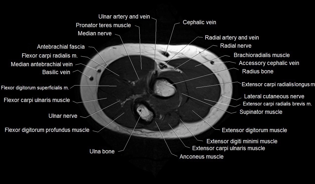 MRI 3T forearm axial cross sectional anatomy image 12.webp